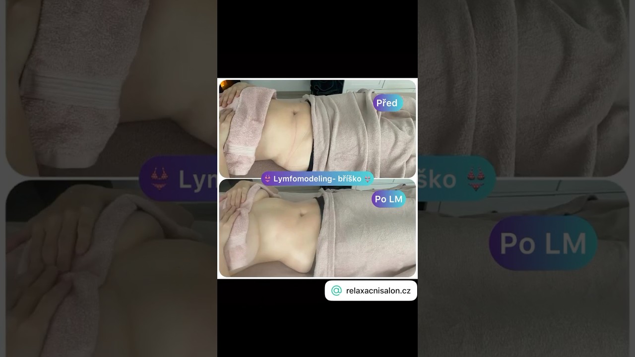 Lymfomodeling